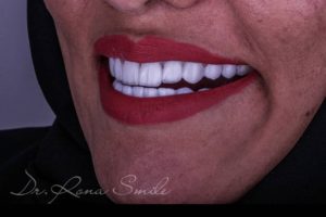 الدكتورة رونا رباح - فينير ابتسامة هوليوود سمايل